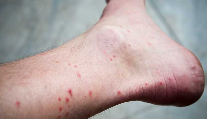Flea bites are tiny swollen bumps