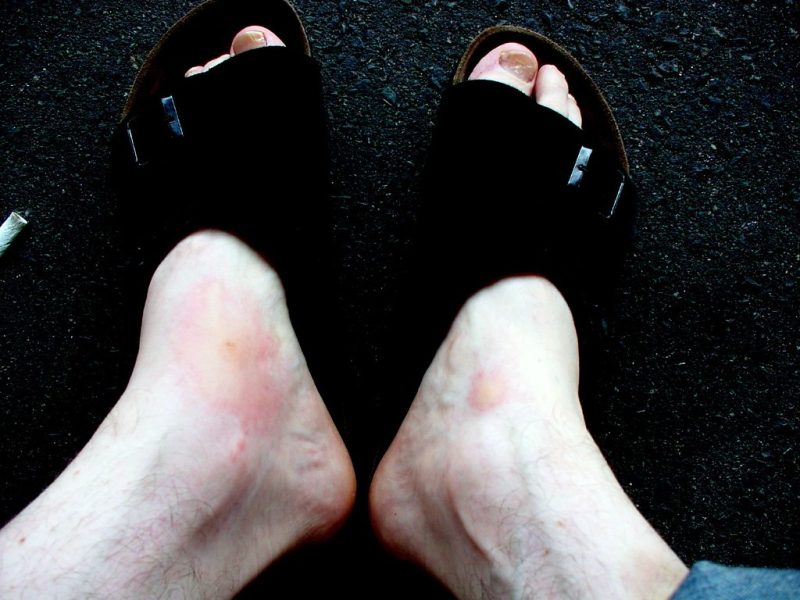 Mosquito Bites!!