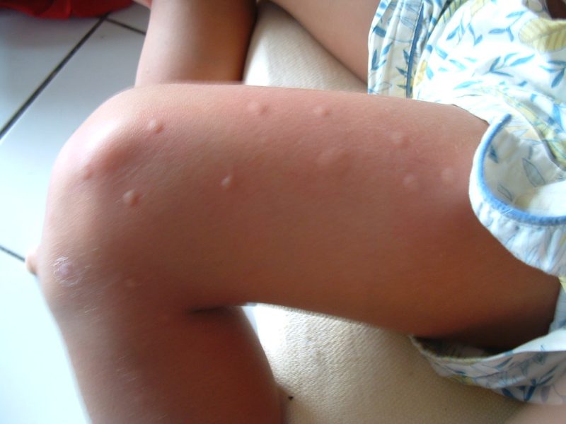 Mosquito Bites